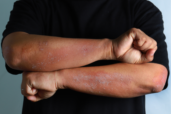 Understanding the Atopic Dermatitis (Eczema) Experience of Ethnic Minorities